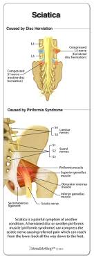Download Sciatic nerve pain pictures 191 images133