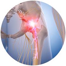 Download Sciatic nerve pain pictures 290 images134