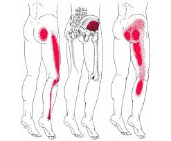 Download Sciatic nerve pain pictures 219 images138