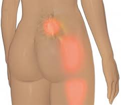 Download Sciatic nerve pain pictures 389 images141
