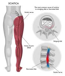 Download Sciatic nerve pain pictures 295 images147