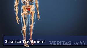 Download Sciatic nerve pain pictures 283 images150