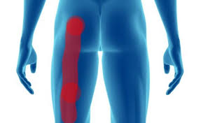 Download Sciatic nerve pain pictures 286 images151