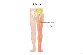 Download Sciatic nerve pain pictures 398 images152