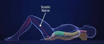 Download Sciatic nerve pain pictures 360 images155