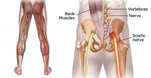 Download Sciatic nerve pain pictures 258 images156