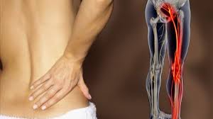 Download Sciatic nerve pain pictures 332 images158