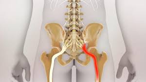 Download Sciatic nerve pain pictures 342 images172