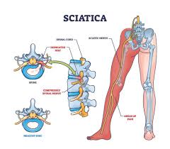 Download Sciatic nerve pain pictures 223 images178