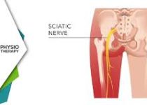Effective Treatment for Severe Sciatica Pain 2 images184