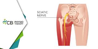 Download Sciatic nerve pain pictures 368 images184