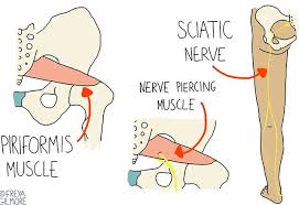 Download Sciatic nerve pain pictures 178 images188