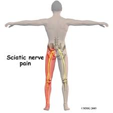 Download Sciatic nerve pain pictures 392 images195