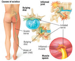 Download Sciatic nerve pain pictures 126 images198