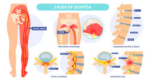 Download Sciatic nerve pain pictures 119 images202