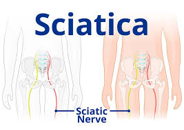 Download Sciatic nerve pain pictures 148 images203