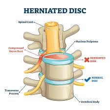 Download Sciatic nerve pain pictures 245 images204