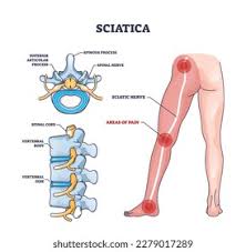 Download Sciatic nerve pain pictures 282 images208