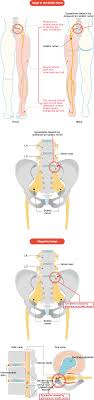 Download Sciatic nerve pain pictures 344 images212