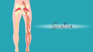 Download Sciatic nerve pain pictures 330 images216