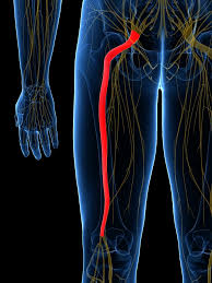 Download Sciatic nerve pain pictures 115 images220