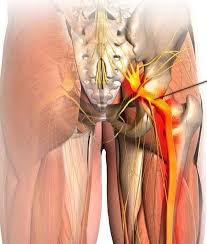 Download Sciatic nerve pain pictures 209 images225