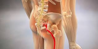 Download Sciatic nerve pain pictures 365 images226