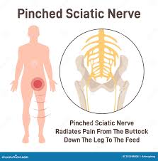 Download Sciatic nerve pain pictures 221 images23