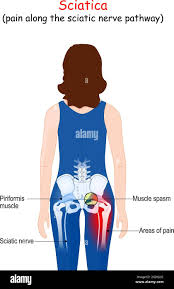 Download Sciatic nerve pain pictures 184 images235