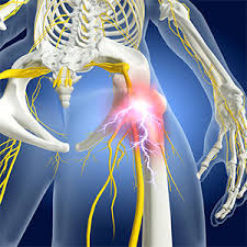 Download Sciatic nerve pain pictures 90 images238