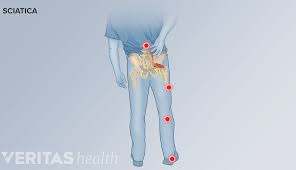 Download Sciatic nerve pain pictures 399 images245