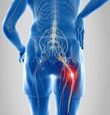 Download Sciatic nerve pain pictures 240 images248