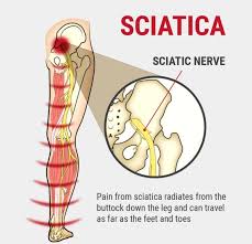 Download Sciatic nerve pain pictures 196 images25