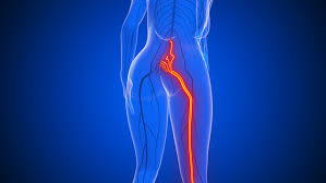 Download Sciatic nerve pain pictures 292 images258