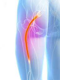 Download Sciatic nerve pain pictures 378 images260