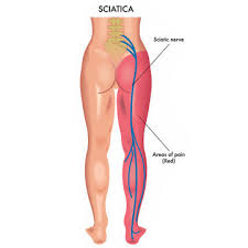 Download Sciatic nerve pain pictures 340 images265