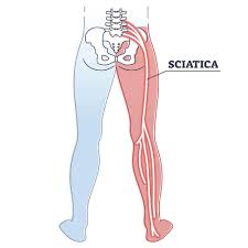 Download Sciatic nerve pain pictures 383 images266