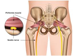 Download Sciatic nerve pain pictures 232 images27