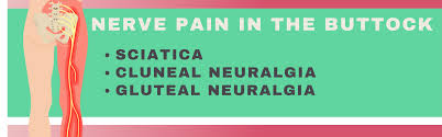 Download Sciatic nerve pain pictures 151 images28