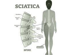 Download Sciatic nerve pain pictures 343 images3