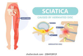 Download Sciatic nerve pain pictures 247 images38