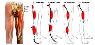 Download Sciatic nerve pain pictures 203 images39