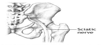 Download Sciatic nerve pain pictures 358 images42