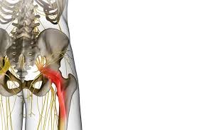 Download Sciatic nerve pain pictures 315 images44