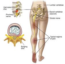 Download Sciatic nerve pain pictures 234 images49