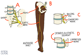 Download Sciatic nerve pain pictures 147 images53