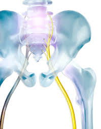 Download Sciatic nerve pain pictures 260 images56