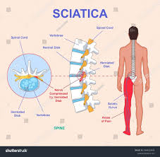 Download Sciatic nerve pain pictures 152 images58