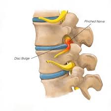 Download Sciatic nerve pain pictures 372 images59