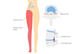 Download Sciatic nerve pain pictures 387 images61